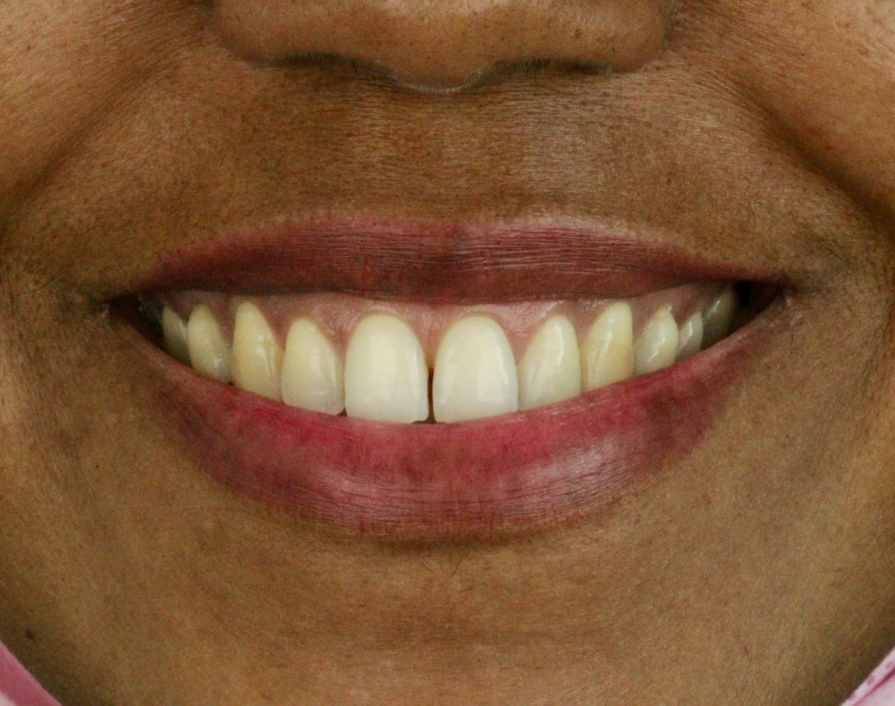 Dentes antes do clareamento dental