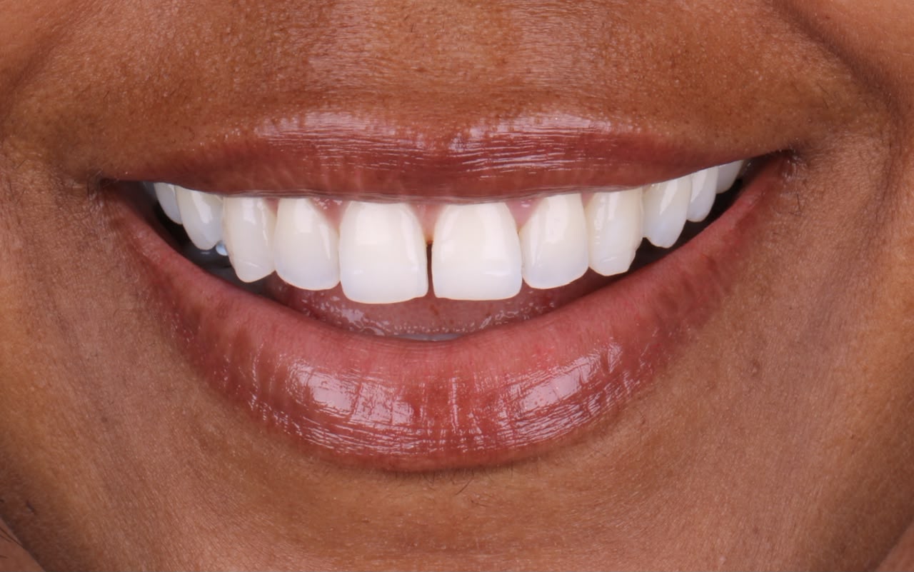 Dentes depois do clareamento dental