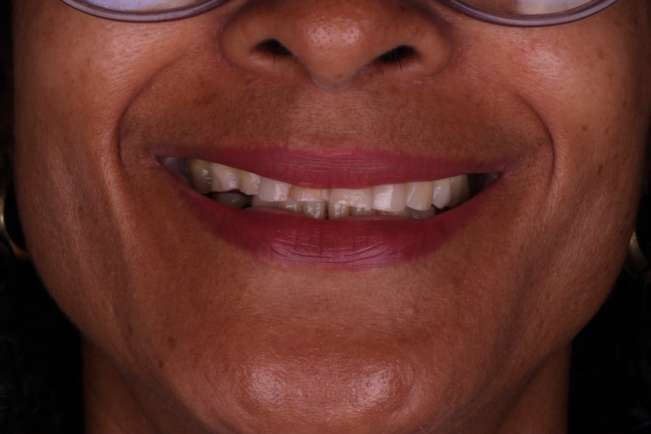Sorriso antes do tratamento odontológico