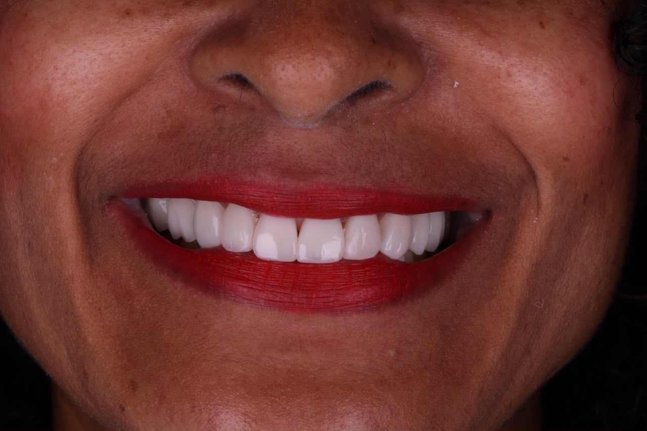 Sorriso depois do tratamento odontológico